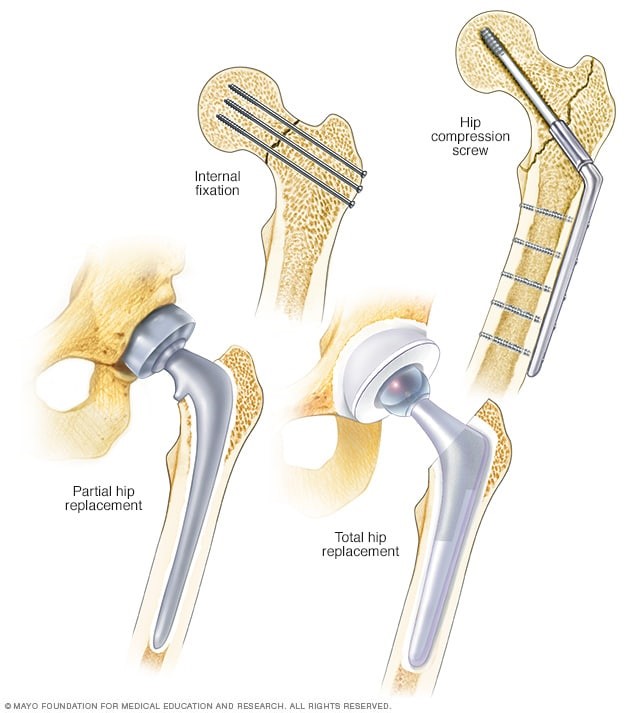 Nursing Diagnosis For Hip Fractures - Diagnosis | Treatment | Care Plans