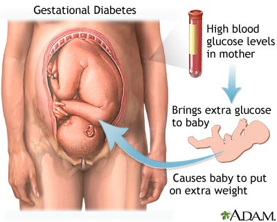 Gestational diabetes1