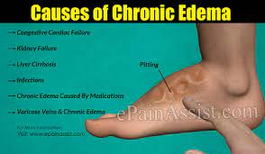 Nursing Care Plans For Edema Plus Interventions With Examples