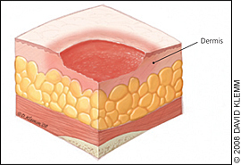 Nursing Diagnosis For Pressure Ulcer, Care Plans and Interventions with ...